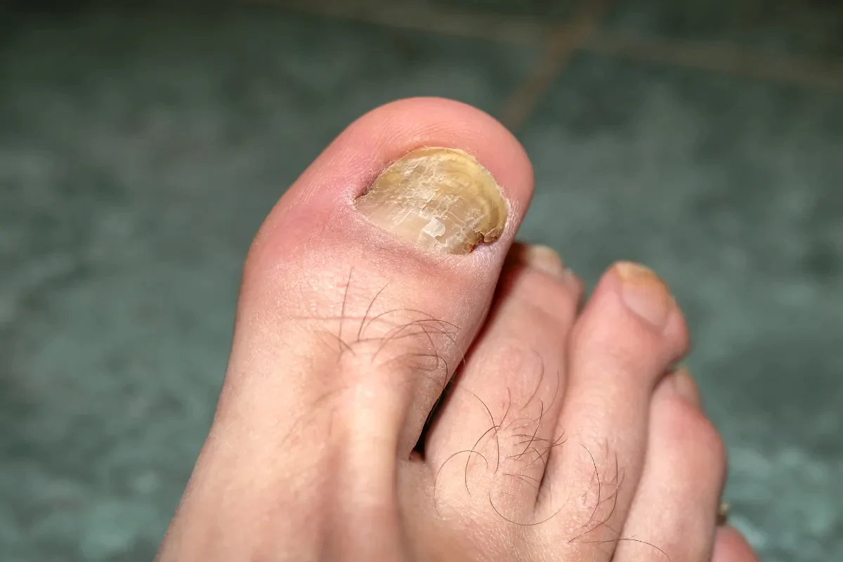 grzybica paznokci u nóg